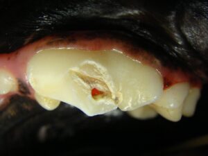 Pulp exposure on a fractured upper fourth premolar