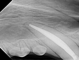 Dental x-ray of a right upper canine after root canal treatment