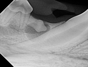a dentigerous cyst involving the right mandibular first molar