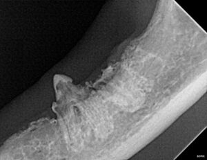 Tooth resorption on the left mandible.